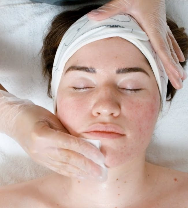 Salicylic Acid Peel