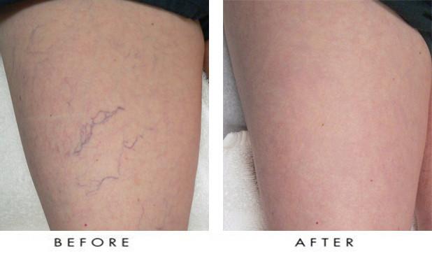 Laser Vein