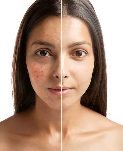 Jessner's Peel