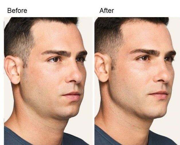 Radiesse Jawline Package (4)