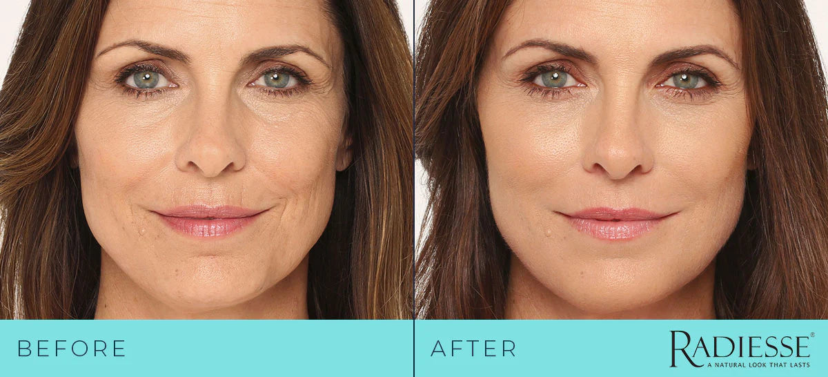 Radiesse Biostimulator Package (2)