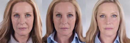 Sculptra Aesthetics